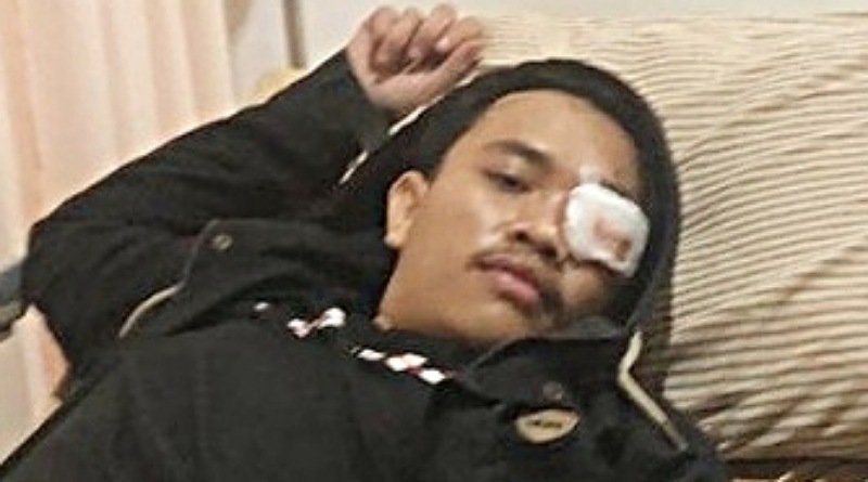 Bola Mata Kiri Andi Andriana, Korban Aksi Unjuk Rasa Penolak Revisi UU Pilkada Terancam Buta