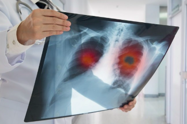 Pengakuan Dokter Kena Kanker Paru Stadium 4, Ini Gejala Awal yang Dirasakan