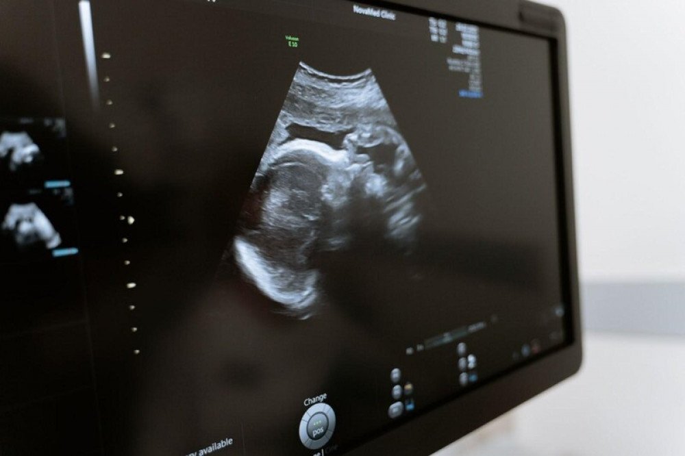 Kemenkes Tindak Dokter Obgyn Garut, Dugaan Pelecehan Saat USG Diusut
