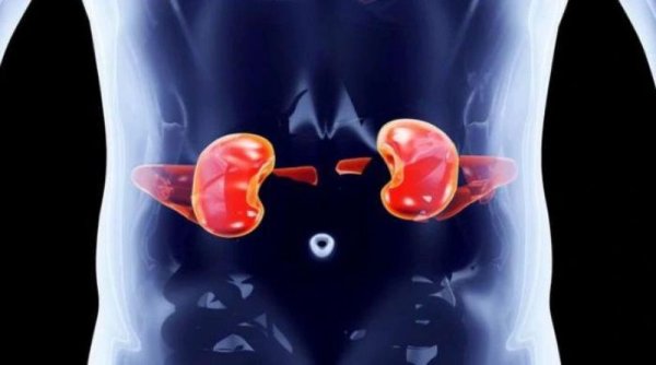 Batu Ginjal Sulit Dihancurkan, Ini Tips Dokter untuk Mengeluarkannya