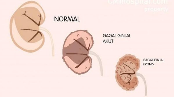 Gagal Ginjal Kronis: Penyebab, Risiko, dan Pencegahan