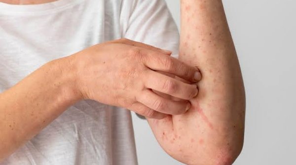Penyakit Lupus: Penyakit Autoimun yang Menyerang Berbagai Organ dan Jaringan dalam Tubuh