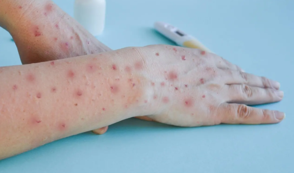 Sierra Leone Umumkan Darurat Kesehatan Akibat Mpox, Penyebaran Meluas ke China dan Prancis