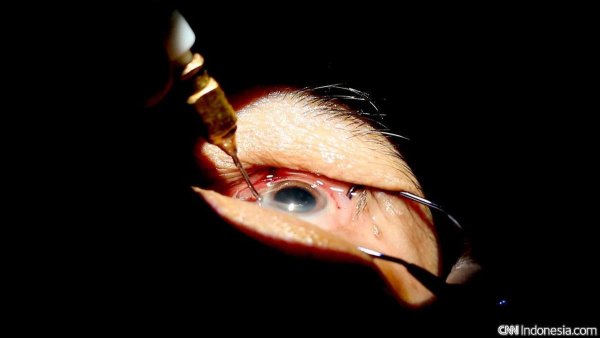 Perawatan Mata Pasca Operasi Katarak Agar Cepat Pulih